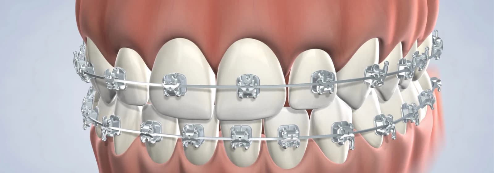 braces-care-procedure-desktop