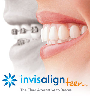 invisalign-for-teens